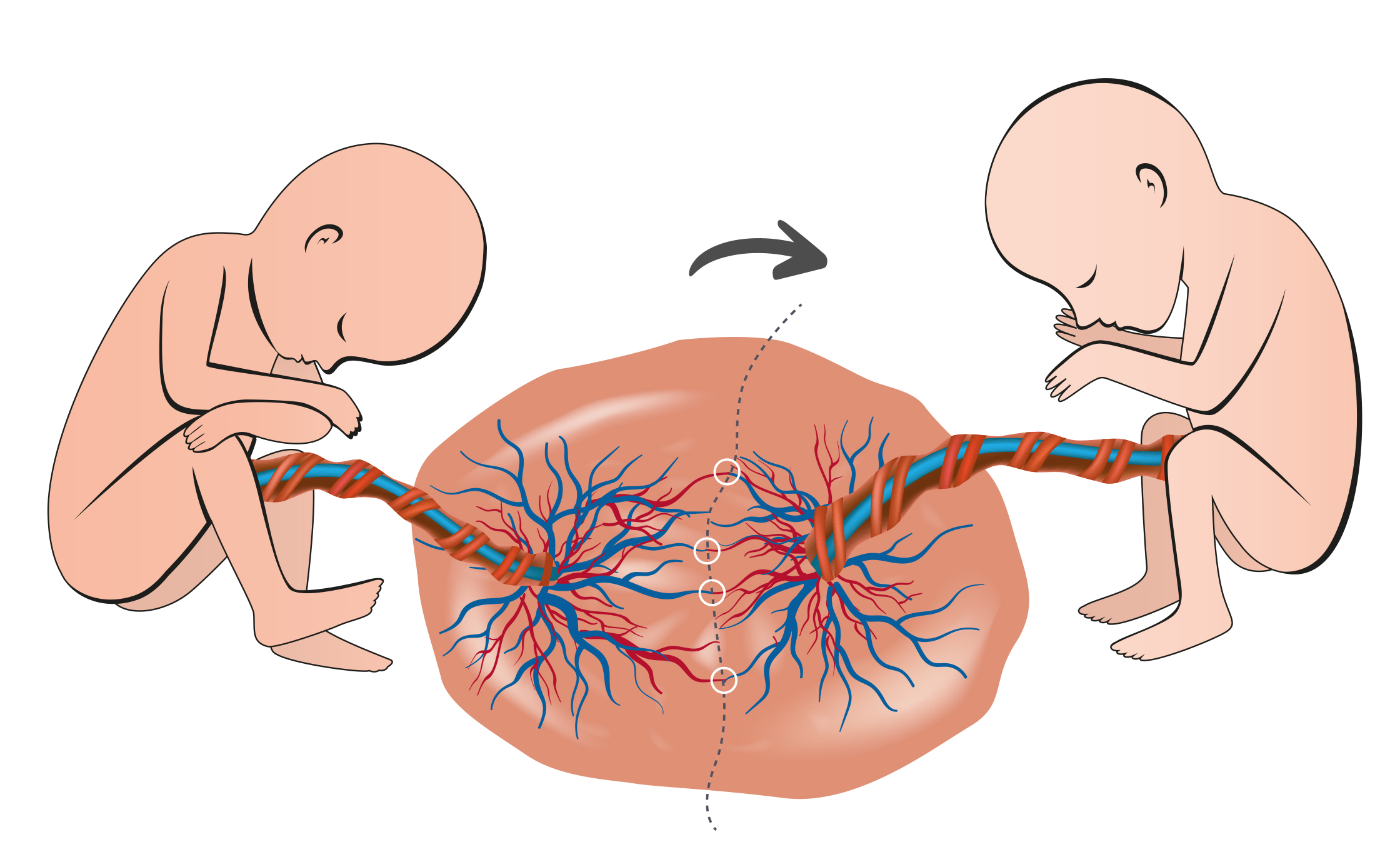 Syndrome Transfuseur Transfusé (STT)
