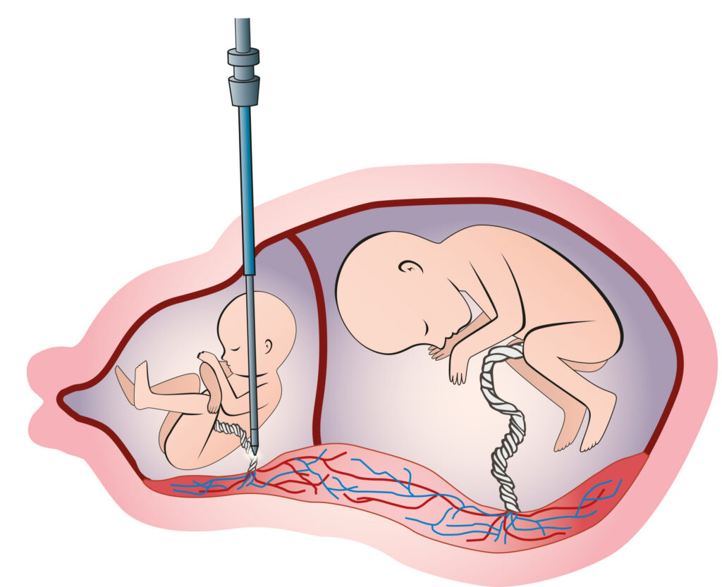 Retard de croissance in utero sélectif sévère (RCIU)