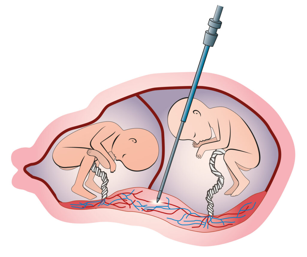 Syndrome Transfuseur Transfusé (STT)
