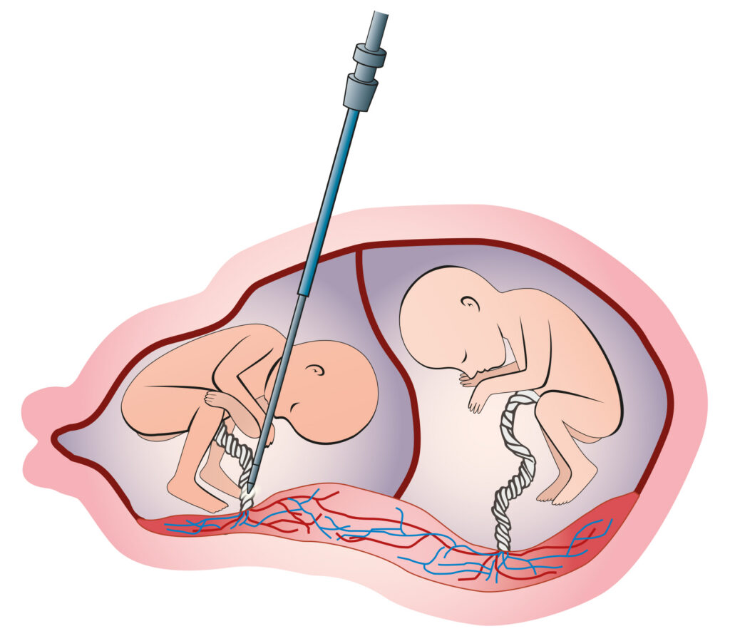 Syndrome Transfuseur Transfusé (STT)