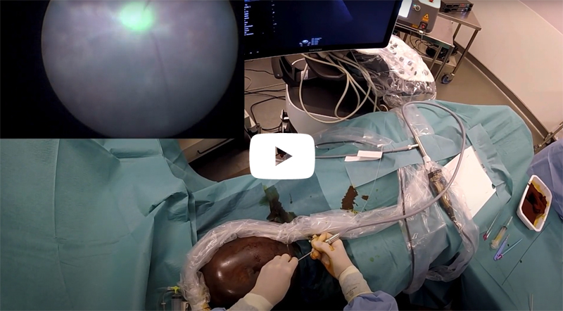Intervention par foetoscopie pour traitement par laser du syndrome transfuseur-transfusé